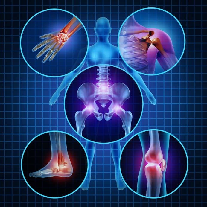 Arthritis Auswirkungen auf Gelenke