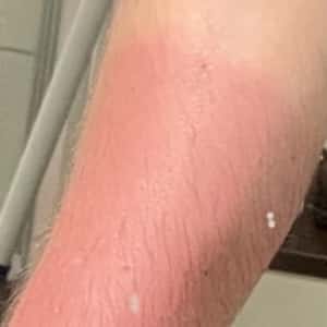 Erfahrungen mit CBD bei Sonnenbrand